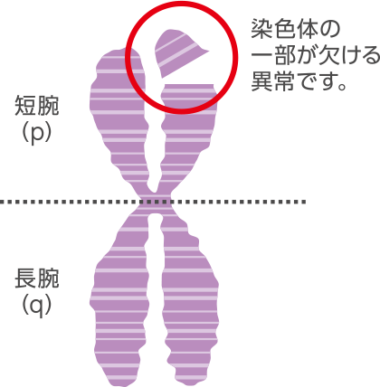 染色体の異常(欠失)の表